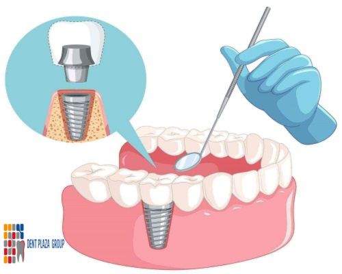 İmplant Diş Tedavisi Sonrası Yapılması Gerekenler Antalya