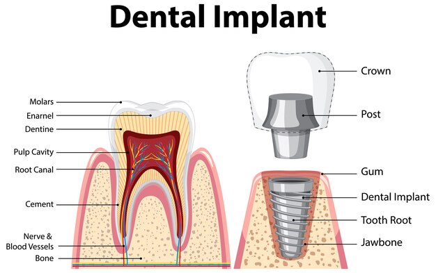 How Long After Dental Implant Can You Put in the Tooth? Dental Clinic Antalya, Turkey