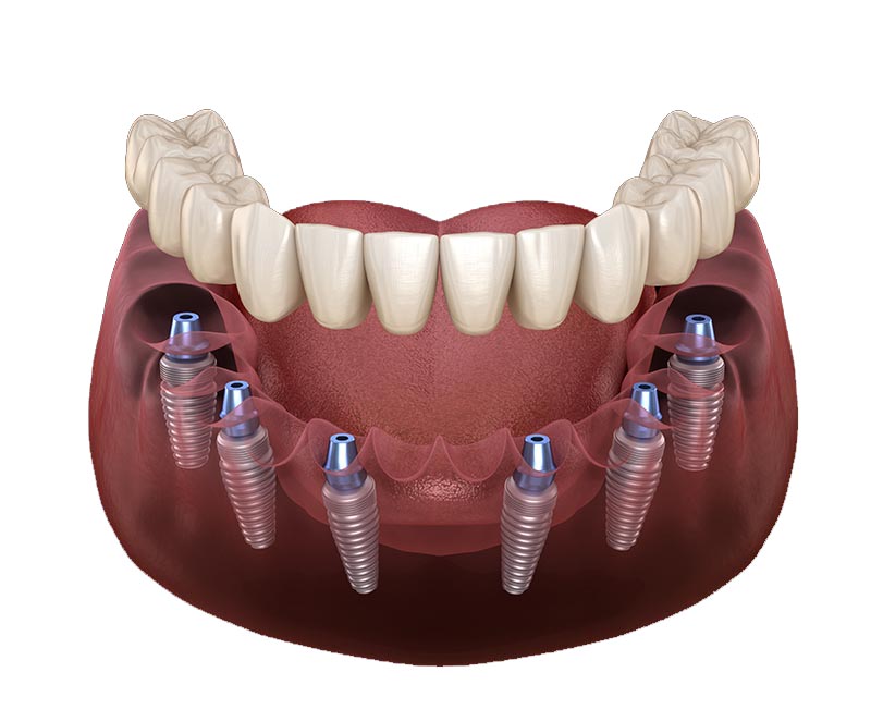 all on 6 implant diş Antalya