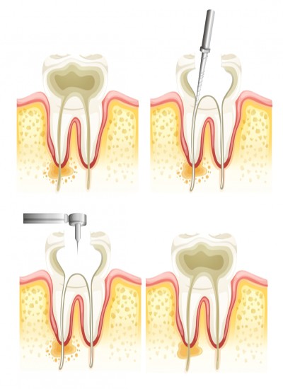 Kanal Tedavisi - Endodonti Nedir? Neden Yapılır? Fiyatları Antalya