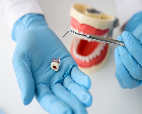 Kanal Tedavisi - Endodonti Nasıl Yapılır? Endodonti fiyatları ne kadardır? Antalya
