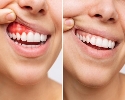 Periodontoloji nedir? - Diş Eti Hastalığı- Periodontist, Diş eti çekilmesi, şişmesi, iltihabı tedavisi, fiyatları Antalya