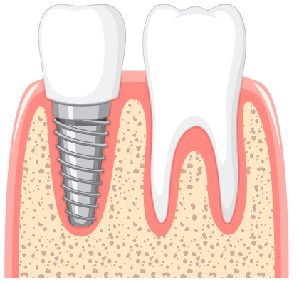 All on 4 implant diş Antalya