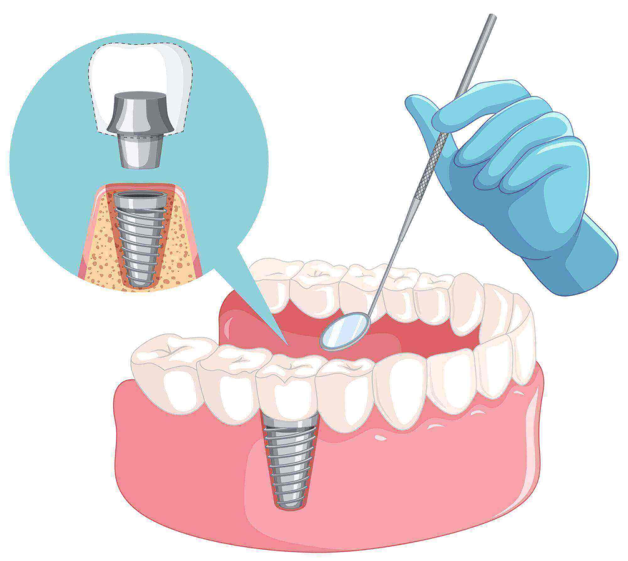 İmplant Diş Tedavisinde Yöntemler, vidalı diş, öncesi, sonrası, fiyatları Antalya