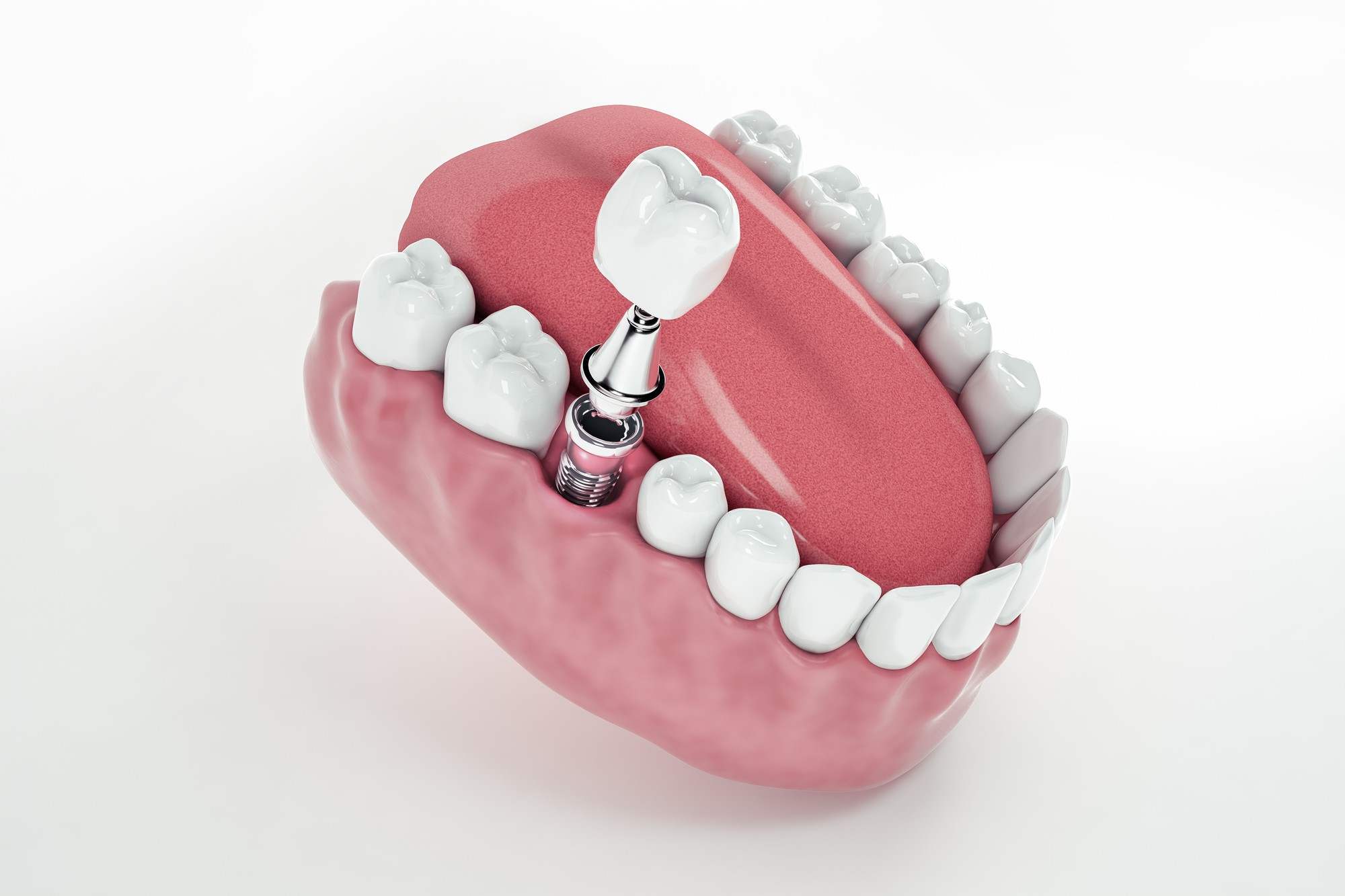 implant diş kliniği Antalya