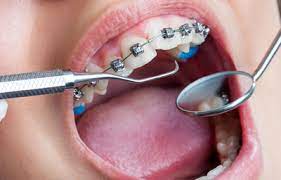 Orthodontic Treatment Prices Antalya