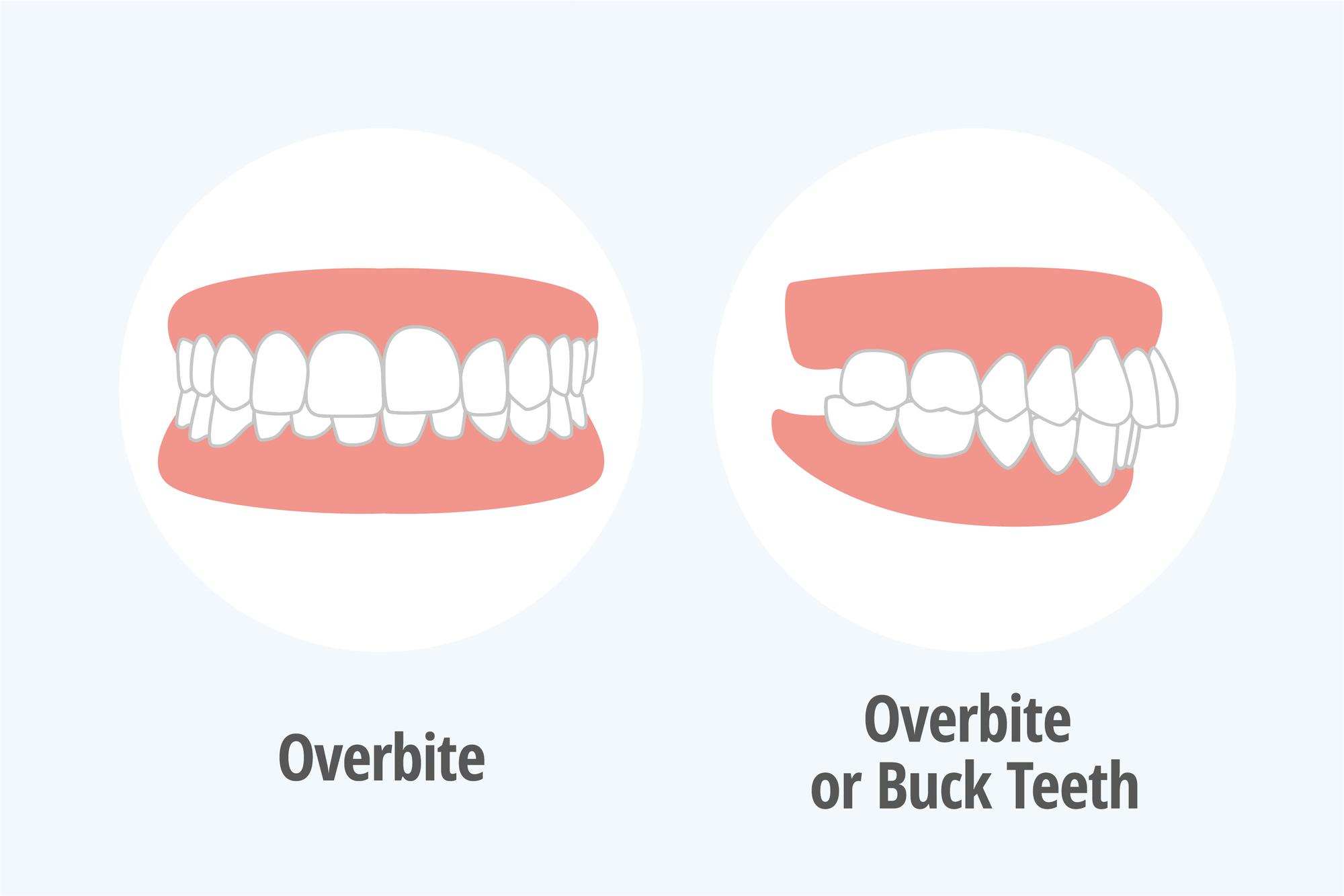 overbite / parent Plaque, Braces? Transparent Braces, Plaque Prices