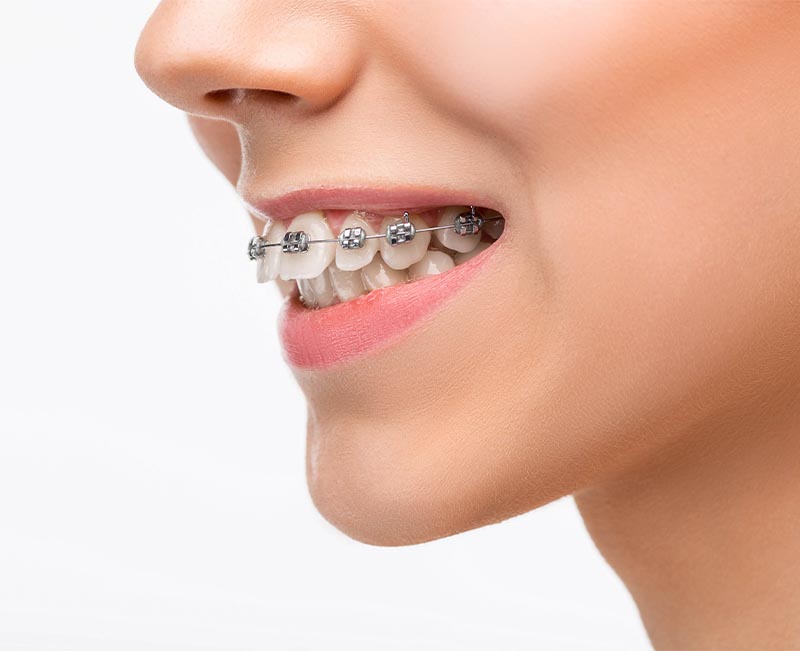 Ortodonti Nedir? Neden yapılır? Diş teli tedavisi, Fiyatları Antalya